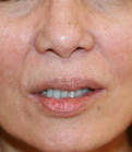 Feel Beautiful - Upper Lip Lift 215 - Before Photo